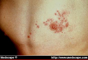 HERPES Y VACUNAS COVID